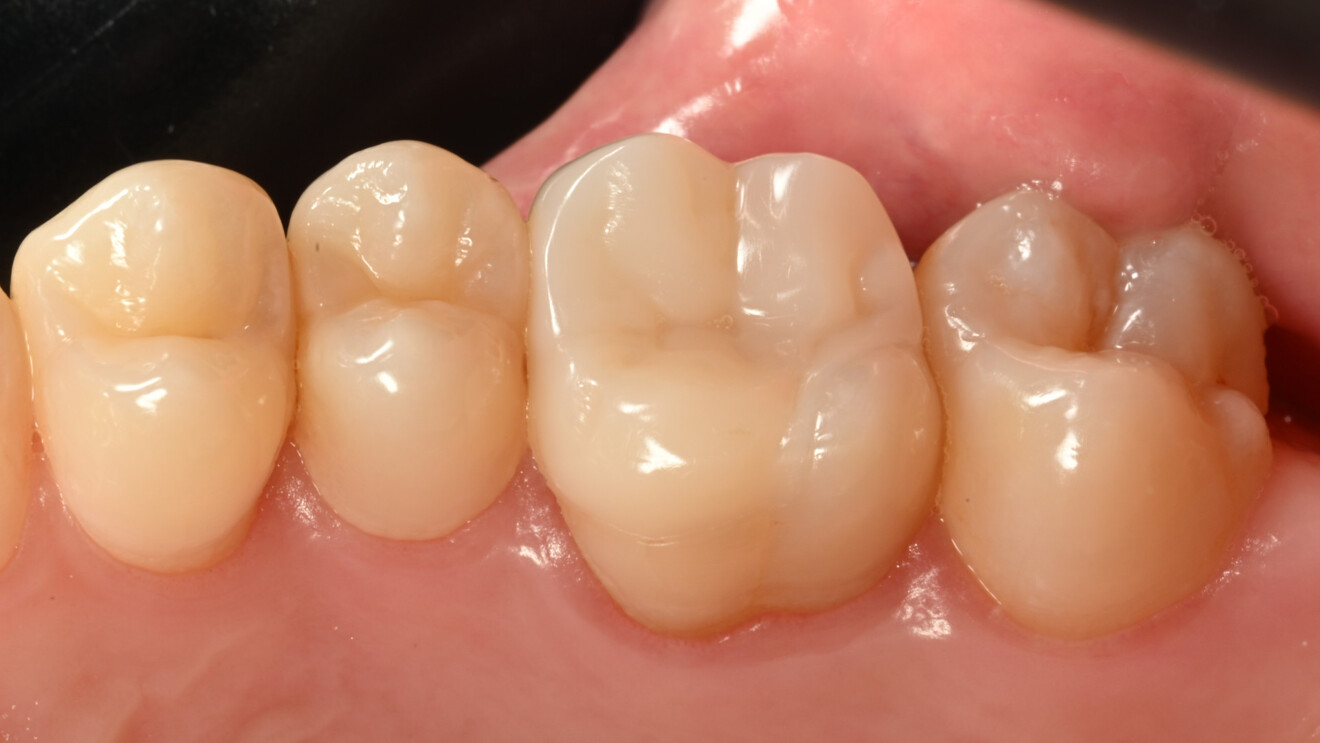 Fig. 33a: Restoration at the nine-month recall, showing stain-free margins and smooth surfaces owing to excellent polish retention, occlusal view.