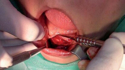 Miniimplanty systemu Bego-Semados na przykładzie klinicznym