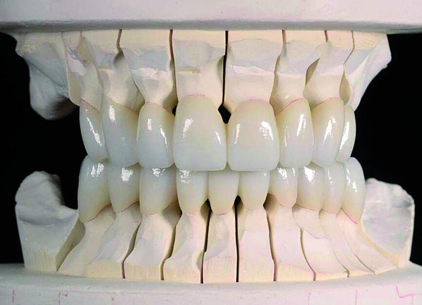 Fig. 10: Milled restorations on Stratos 100 articulator from Ivoclar Vivadent.