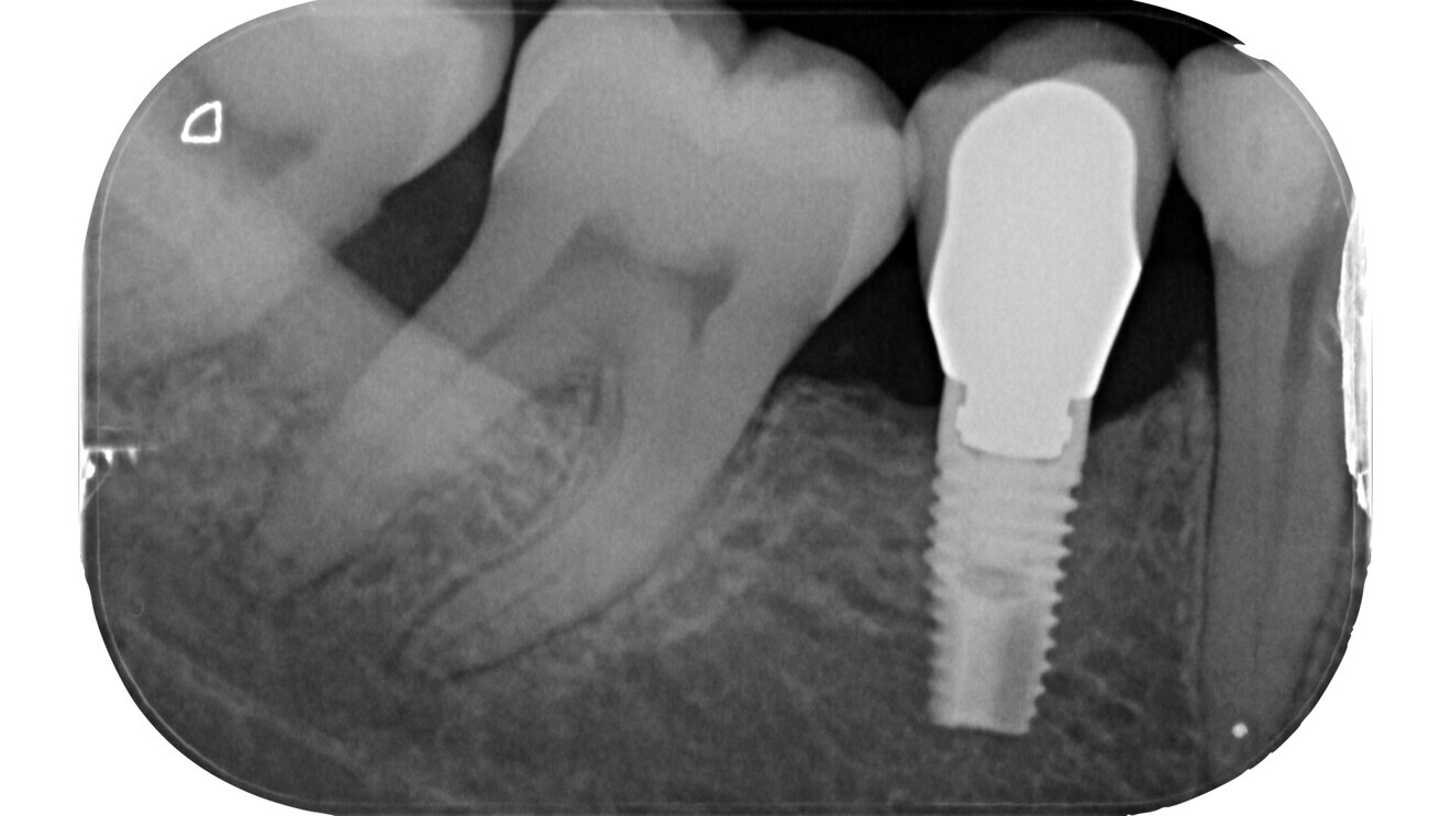 Fig. 6: Pre-op radiograph of a mesially tilted mandibular molar with irreversible pulpitis (probable colonisation from the distal periodontal lesion).