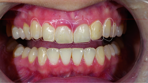 Digital implantology— Predictable aesthetics and functional results