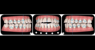 Allineatori trasparenti in tecnica Invisalign, Surgery First in caso di recidiva di iperplasia condilare