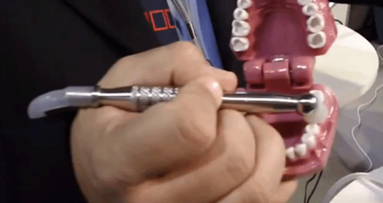 Las grandes ventajas del ozono para el tratamiento de la caries dental