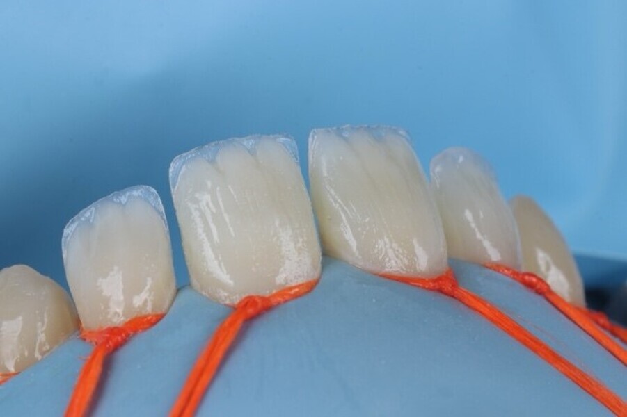 Fig. 3h: Dentin layer build up with beautifil ii ls shade a1 on all 4 upper incisal teeth.
