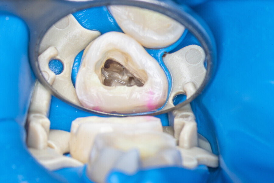 Fig. 19: The pulp chamber of the second molar. The MB2 orifice was located closer to the palatal canal.