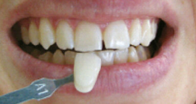 TouchWhite – příští generace v bělení zubů