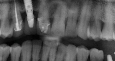 Impianti a connessione conometrica: semplificazione protesica in zona anteriore