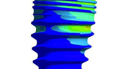 Implantologie: Webinar beleuchtet Grundlagen der Knochenbeanspruchung