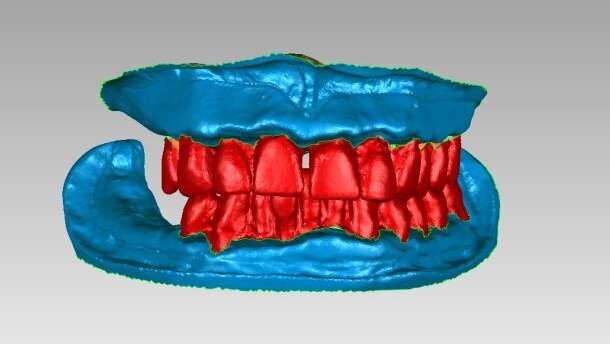 Precisie, efficiëntie en voorspelbaarheid met de Digitale AvaDent-immediaatprothese