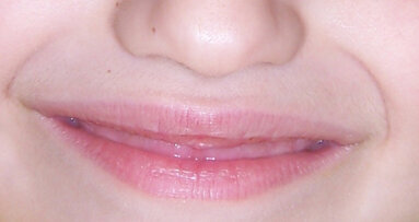 Estetica e salute del sorriso del bambino