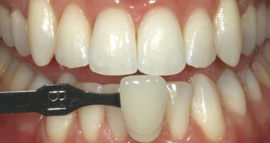 Técnica de aclaramiento dental en el consultorio