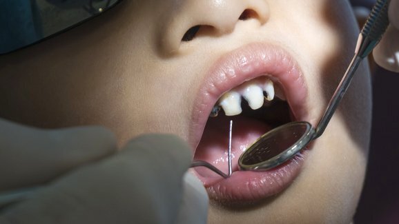 Cáries em crianças: Dentistas ingleses extraem 160 dentes um dia