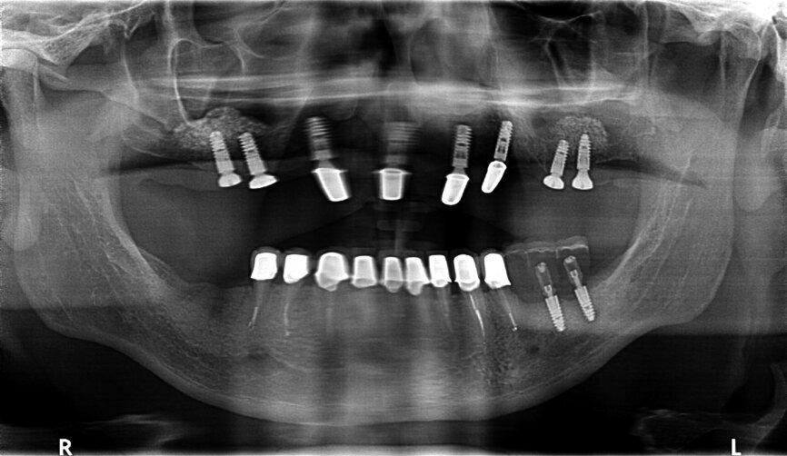 Fig. 31: OPG after exposing implants at the lateral section and having used a temporary prosthesis based on telescopes.