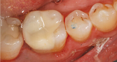 Crown or same-day onlay?