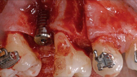 Chirurgicky akcelerovaná ortodontická terapie jako součást multidisciplinární implantologické léčby
