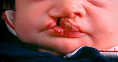 „Wir haben eine Region auf Chromosom 8 identifiziert, quasi das Haupt-Gen für Lippen-Kiefer-Gaumenspalten.“