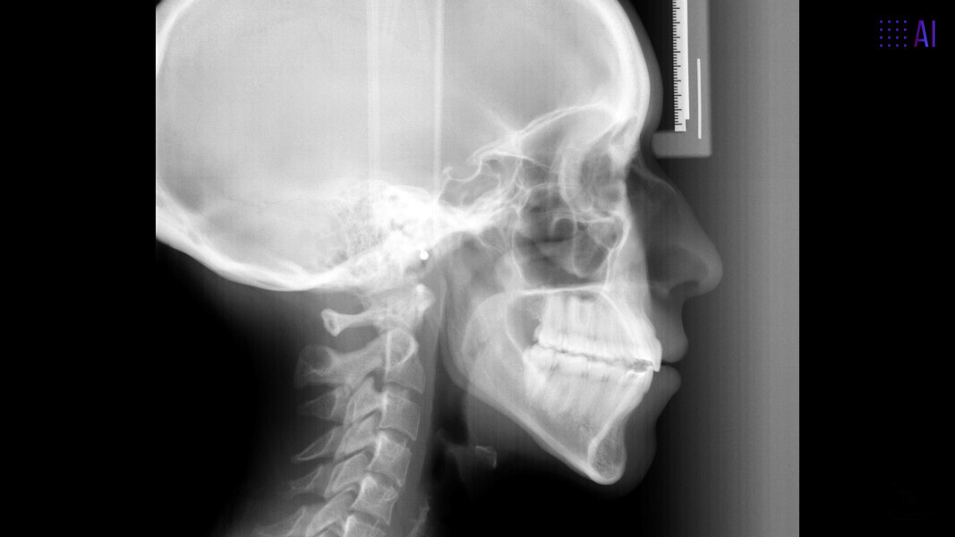 Fig. 18: Final lateral radiograph.