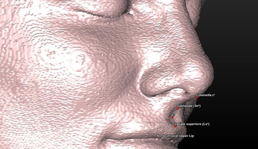 ig. 4_Ricostruzione 3D dei tessuti molli del paziente con visione dei landmark utilizzati.