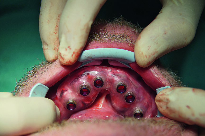 Fig. 14 : Insertion du gabarit dans la mandibule.