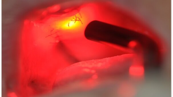 Osteonekroza występująca po zastosowaniu bisfosfonianów – opis przypadku