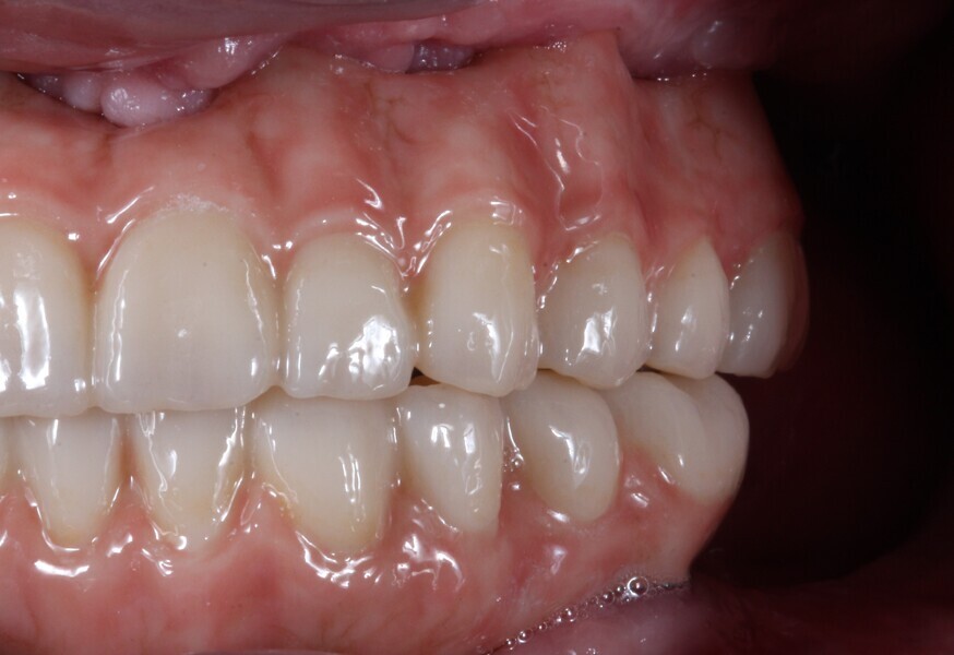 Fig. 20: Final prostheses, left side view.