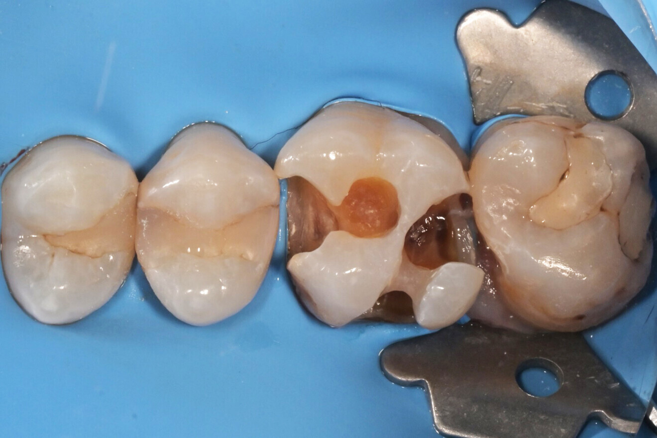 Фиг. 2: Зъбът след препарация.ес два месеца след лечение с цинк-оксид-евгенолова паста. 