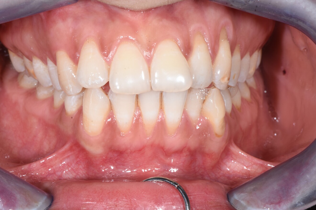 Figg. 1-3 - Situazione iniziale arcata superiore e inferiore, foto intraorali.