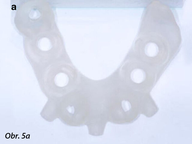 Chirurgické šablony vyrobené CAD/CAM technikou: s oporou o zub a sliznici (a) a implantát a sliznici (b).