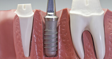 Strom soll Implantate von Bakterien befreien