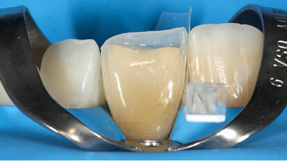 Essentia – Chytré zjednodušení kompozitního systému!