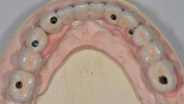 Rehabilitacja bezzębia w żuchwie przy użyciu 6 implantów