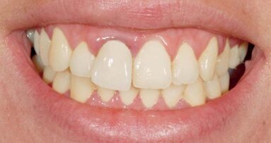 Implantacja natychmiastowa Ankylos® C/X