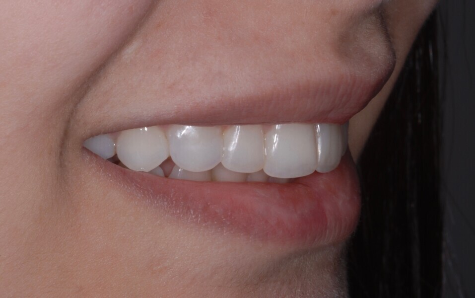 Fig. 20: Smile right side view after treatment.