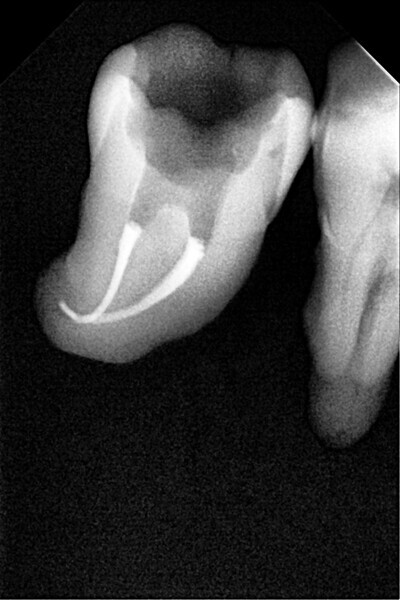 Fig. 22: Radiograph after removal of 3–5 mm of the gutta-percha from the root canals.