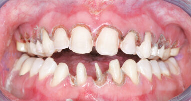 Redukce “gummy smile” zvýšením skusu