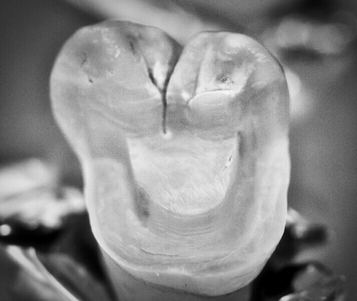 Fig. 1: Preparation of tooth.