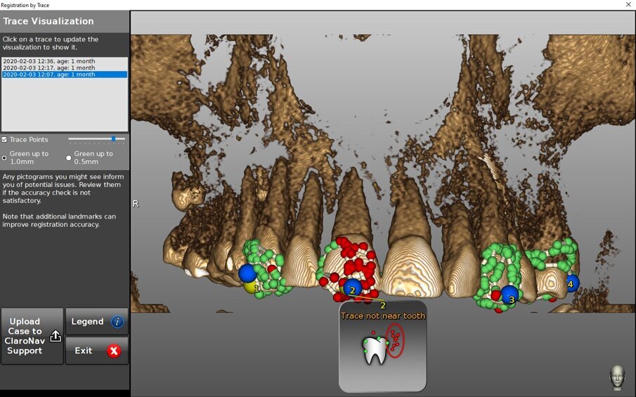 Figg. 7a, 7b - Valutazione della qualità della scansione per tastatura sulla base del confronto tra la posizione della punta del tracer rilevata ed i dati 3D della tac. a) Precisione della scansione; b) Legenda delle indicazioni in a.