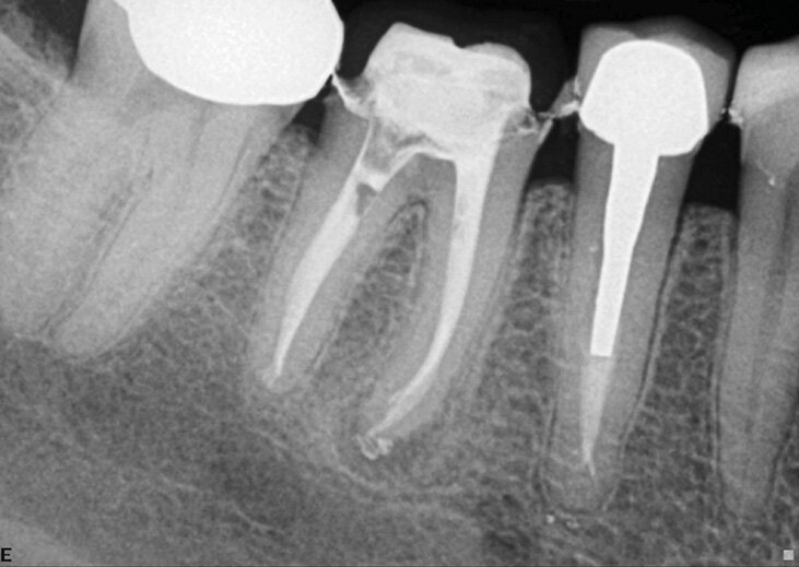 Slučaj 2 – Slika br. 5: Periapikalni kontrolni Rtg snimak odmah nakon tretmana