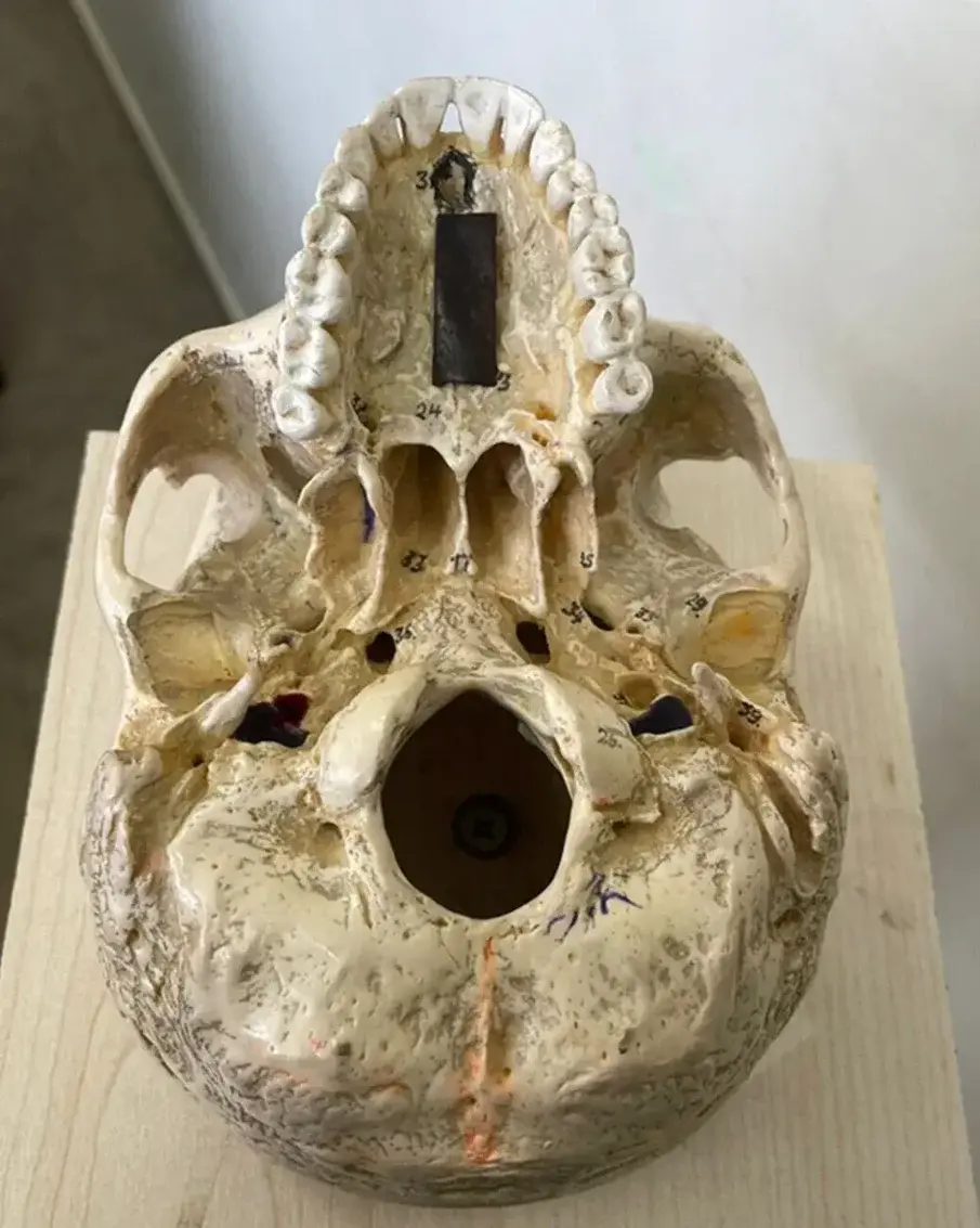 Približan položaj odgovarajuće trake u odnosu na nepce. (Slika: © 2024 Mokhtari et al., Časopis za medicinske znanosti o zračenju, licenciran pod CC BY 4.0)