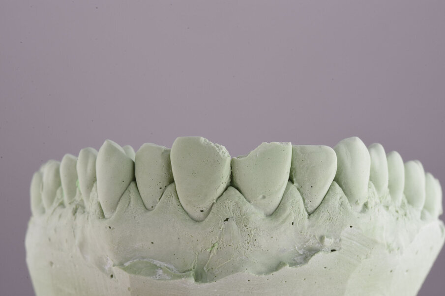 Sl. 5a: Wax up buduće restauracije