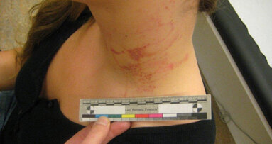 “Ook tandarts moet mishandeling durven en willen signaleren”