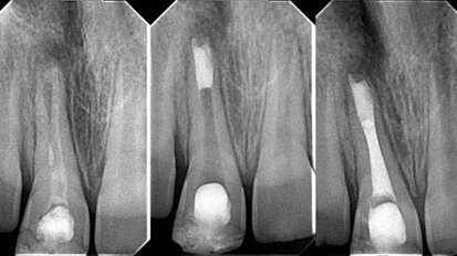 Revascularisation of the necrotic open apex
