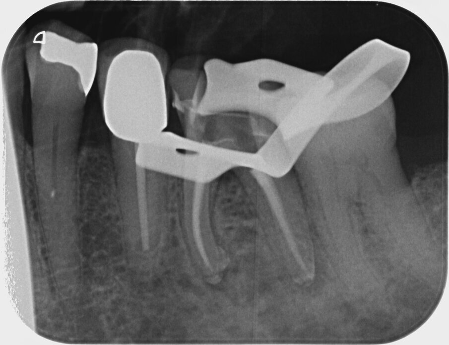 Fig. 15: Radiographic check without cover filling. 