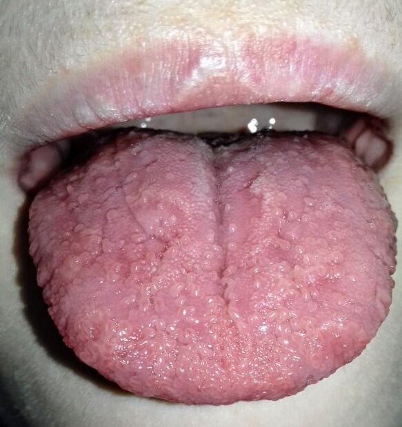 Fig. 2 - Paziente allergico al kiwi, legumi, olio di arachidi, polline degli ulivi e graminacee.