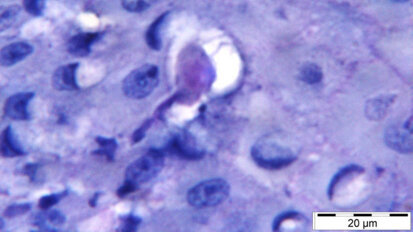 Pesquisadores relacionam ameba à periodontite grave