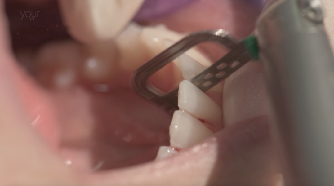 Fig. 10: Using an oscillating handpiece with water spray for IPR in the mandibular arch.