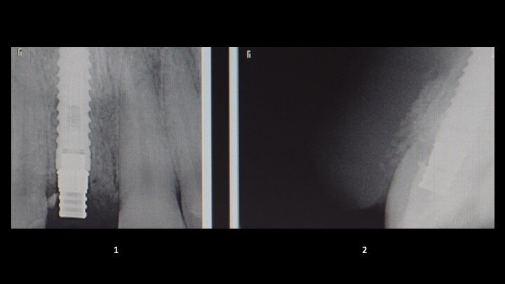 Figura 17. Imágenes de RVG donde se aprecia: 
1. El ajuste perfecto del semicalcinable, ya que el diente no lo vemos al ser de acrílico.
2. La presencia de las partículas de biomaterial en la zona vestibular en contacto con el defecto óseo y las más superficiales, que se incorporarán al tejido conectivo nuevo.

