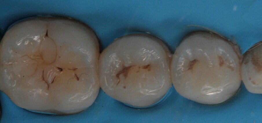 Fig. 25_Isolamento di 45 e 44.