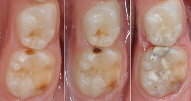 Odontoiatria pediatrica  del minimo intervento: istruzioni per l’uso