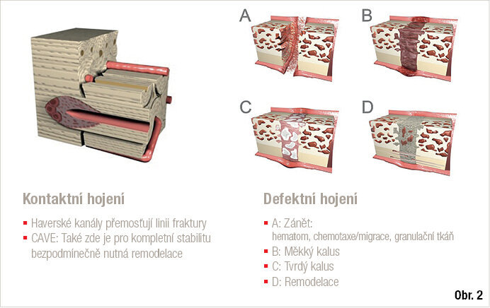 Shrnutí typů kostního hojení: kontaktní hojení (vlevo), defektní hojení (vpravo)